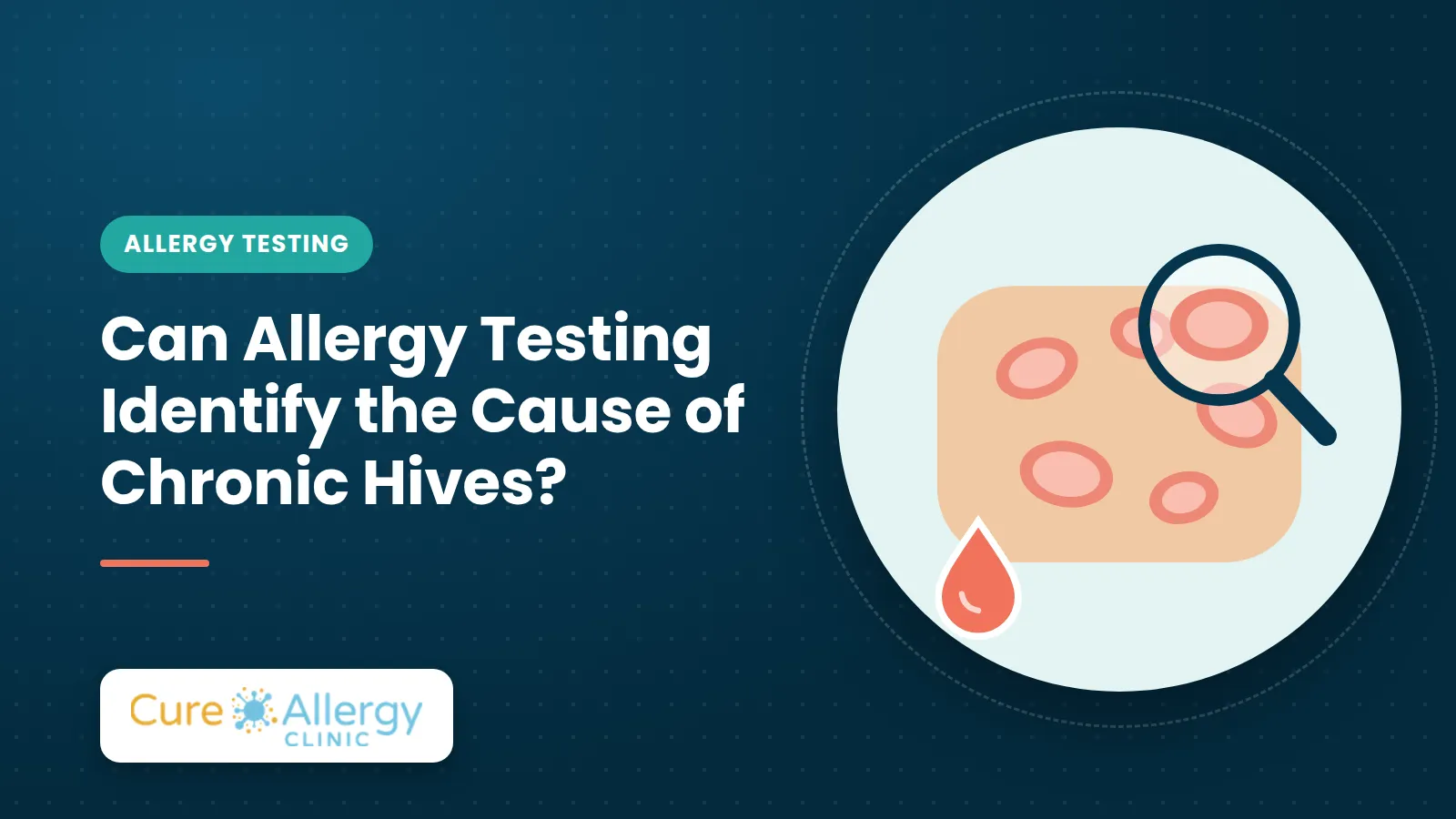 Can Allergy Testing Identify the Cause of Chronic Hives?