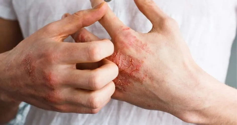 Common Allergies That Make Eczema Worse
