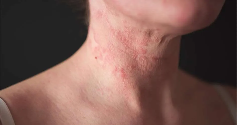 Stop the Winter Itch: Your Guide to Soothing Eczema Flare-Ups Now