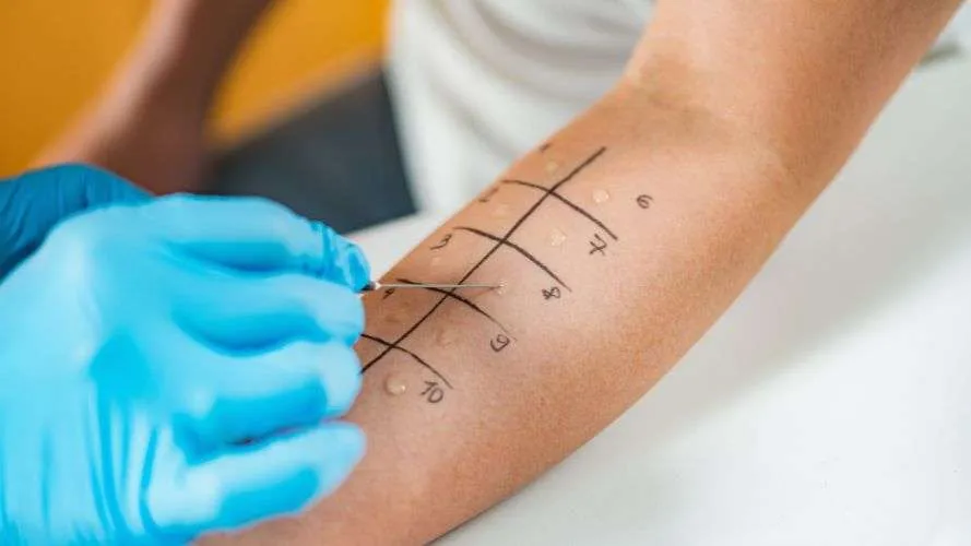 Everything You Need to Know About Skin Prick Test for Allergies