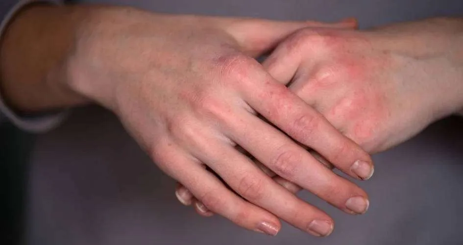 Winter Hand Eczema: Triggers, Treatments, and When to Test for Allergies